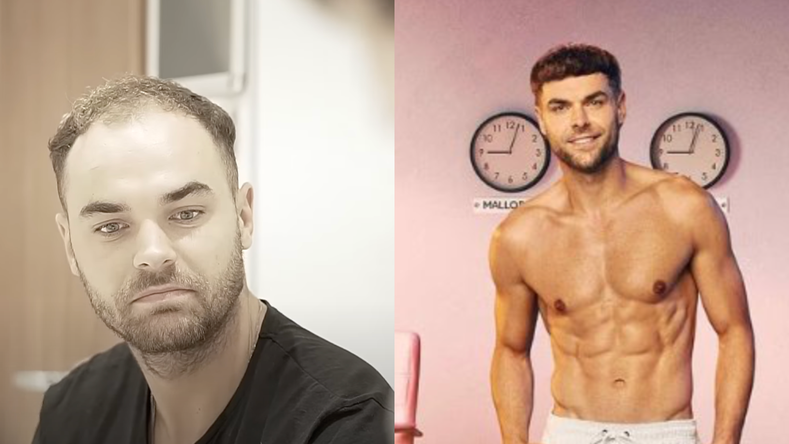 Harry’s Transformation: Love Island Star’s Hair Transplant Journey