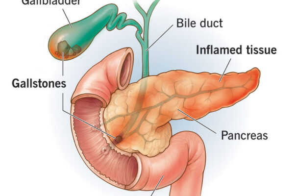 What You Need to Know About Pancreatitis