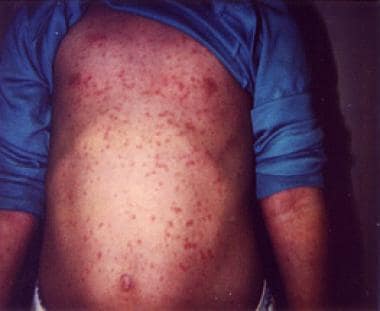 The Facts You Need to Know About Rubella